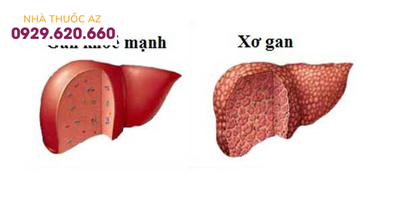 Gan nhiễm mỡ không do rượu không được điều trị kịp thời sẽ dẫn đến xơ gan