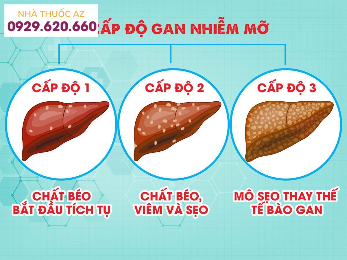 Gan nhiễm mỡ cấp độ 1 chưa ảnh hưởng nhiều đến sức khỏe