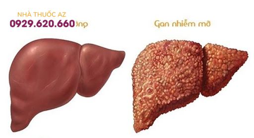 Gan nhiễm mỡ độ 3 có nguy cơ dẫn đến xơ gan