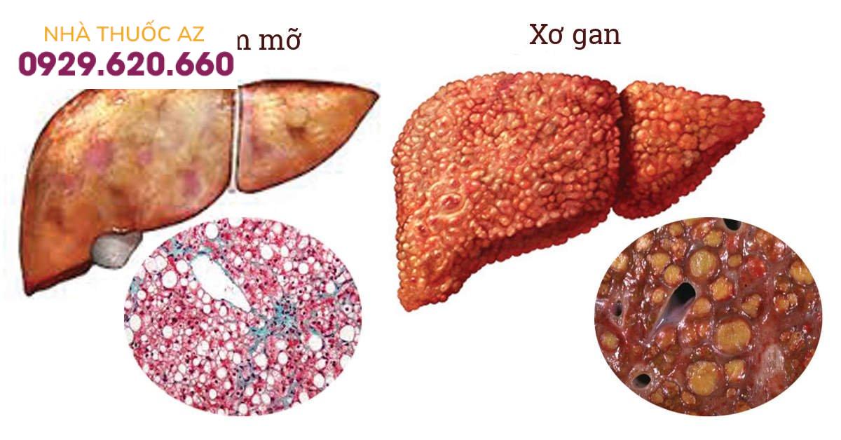 Trẻ em mắc gan nhiễm mỡ