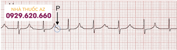 Block nhĩ thất rõ ràng (khoảng PR > 300 ms, sóng P được ẩn trong các sóng T trước).