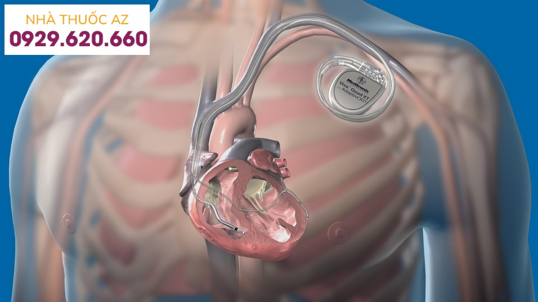 Impantable Cardioversion Defibrillator: ICD)