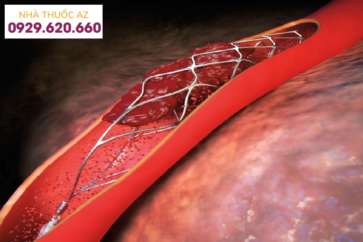 huyết khối trong lòng stent