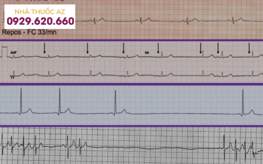 Hình ảnh suy nút xoang trên kết quả ECG