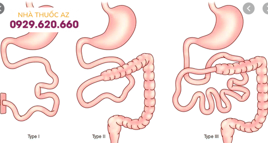 Hình ảnh minh hoạ hội chứng ruột ngắn