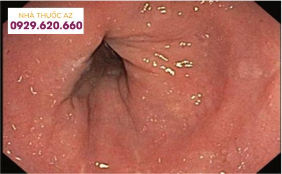 Hình ảnh nội soi của viêm đại tràng vi thể