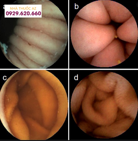 Hình ảnh nội soi viên nang của ruột non