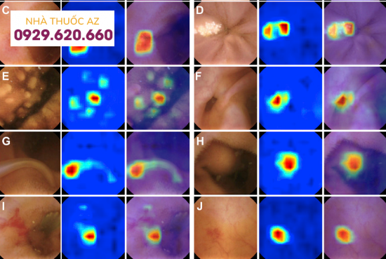 Hình ảnh nội soi viên nang có sử dụng trí tuệ nhân tạo