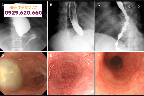 Hình ảnh nội soi và X quang thực quản cản quang của bệnh co thắt tâm vị achalasia