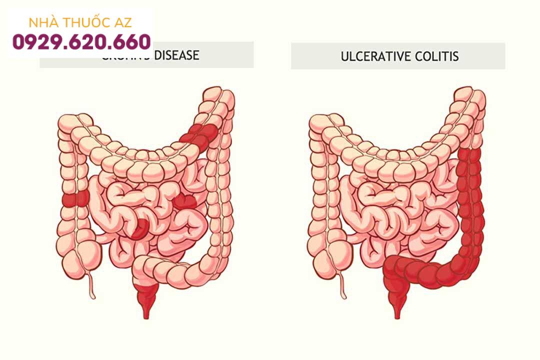 Các giai đoạn của bệnh Crohn