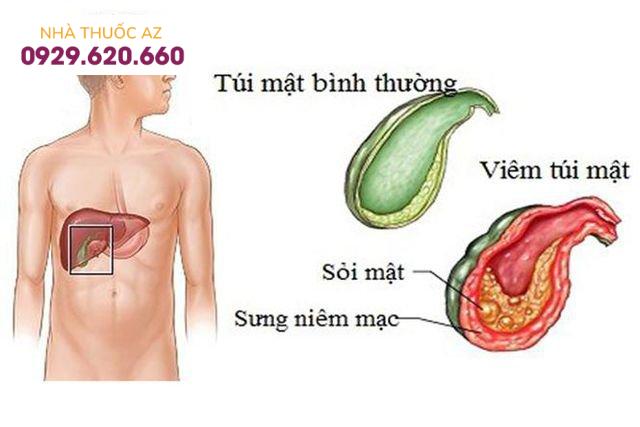 Bệnh Crohn và bệnh túi mật