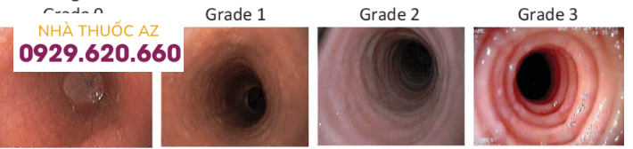 Hình ảnh nội soi của viêm thực quản tăng bạch cầu ái toan
