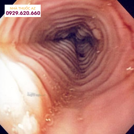Hình ảnh nội soi của viêm thực quản tăng bạch cầu ái toan