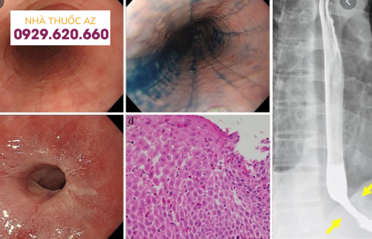 Viêm thực quản bạch cầu ái toan không điều trị, gây các vòng xơ ở đoạn dưới thực quảnViêm thực quản bạch cầu ái toan không điều trị, gây các vòng xơ ở đoạn dưới thực quản