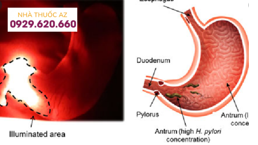 Liệu pháp quang động học trong điều trị H.Pylori