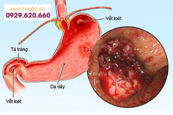 Viêm loét dạ dày