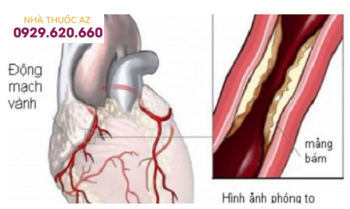 Xơ vữa động mạch