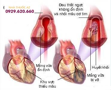 Bệnh mạch vành là gì