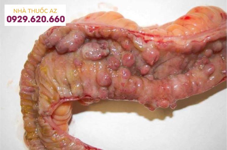 Tổn thương thành trong của ruột trong bệnh Crohn