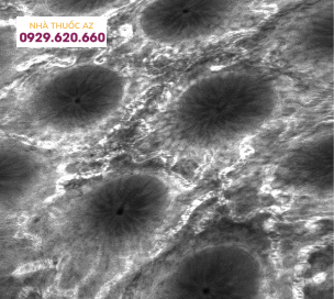 Nội soi bằng laser đồng tiêu