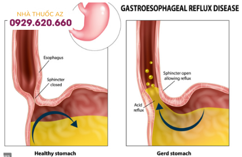 Bệnh viêm thực quản trào ngược.