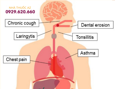 Bệnh trào ngược dạ dày thực quản