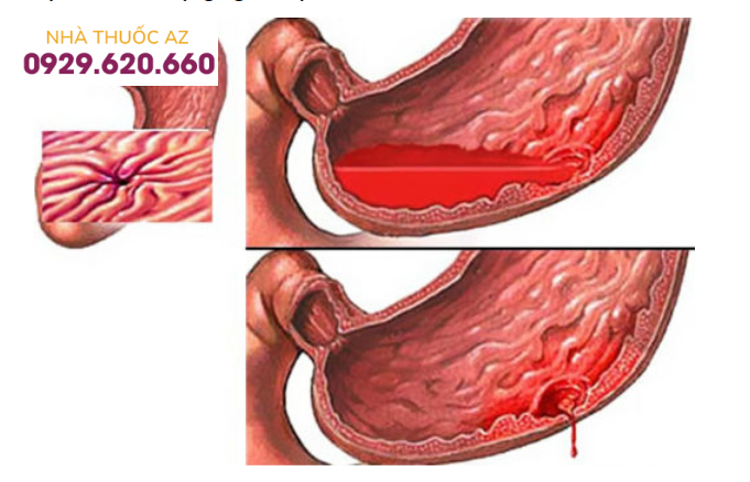 Nguyên nhân gây xuất huyết tiêu hóa trên