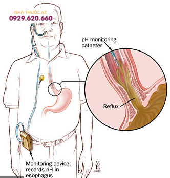 Dụng cụ đo pH thực quản 24 giờ
