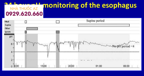 Một kết quản của đo pH thực quản 24 giờ