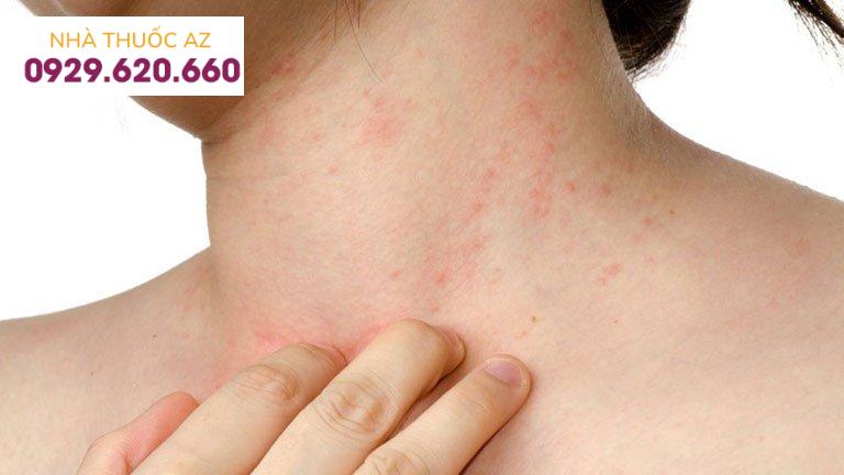 Tác dụng phụ thuốc điều trị viêm loét đại tràng