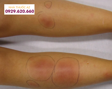 hồng ban nút ở chân ở bệnh crohn