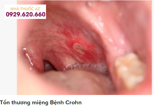 Tổn thương miệng bệnh crohn