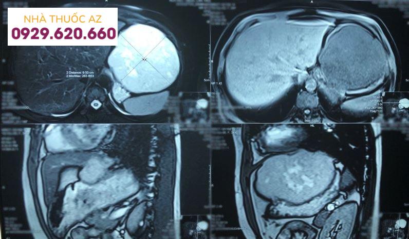 Chụp cộng hưởng từ gan giúp xác định chính xác khối u máu trong gan