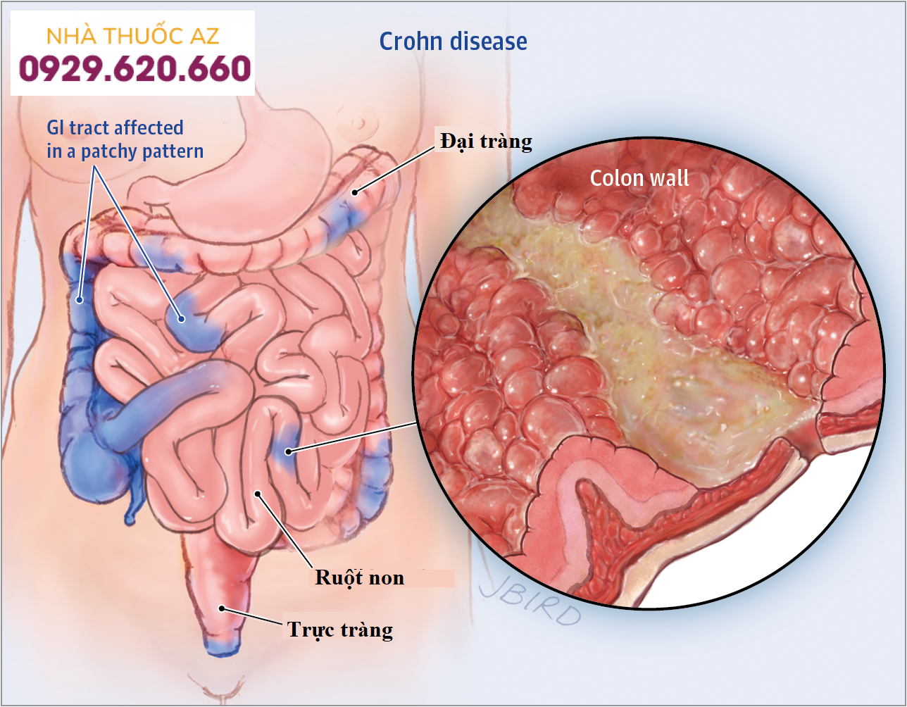Điều trị bệnh Crohn
