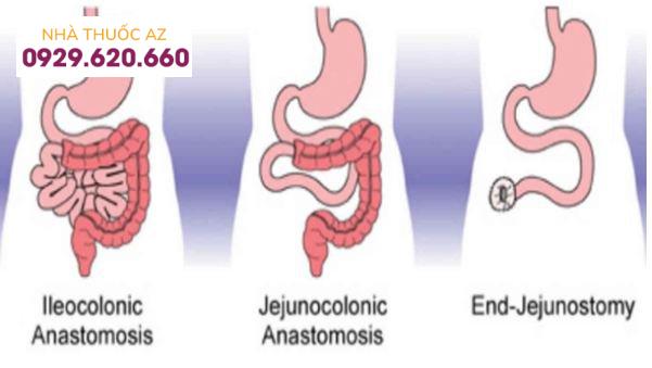 hội chứng ruột ngắn