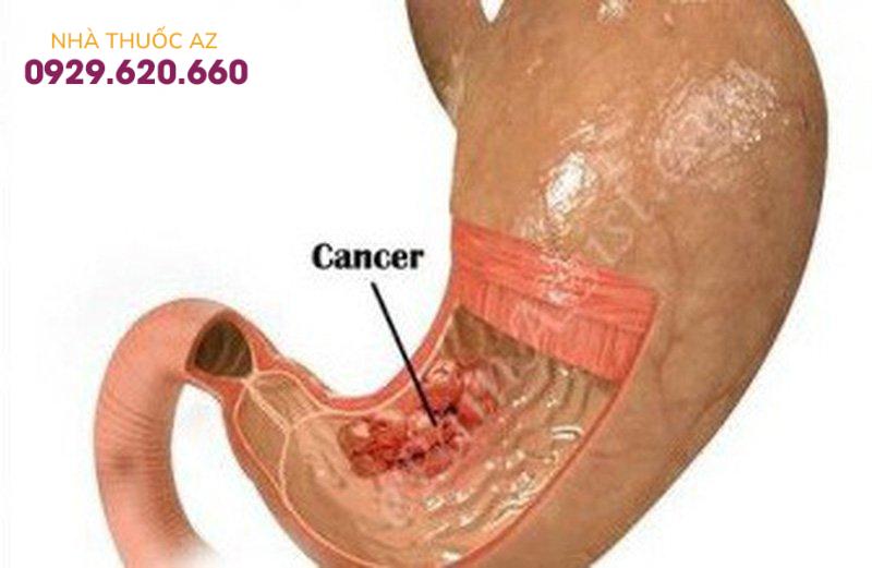 ung thư dạ dày giai đoạn đầu