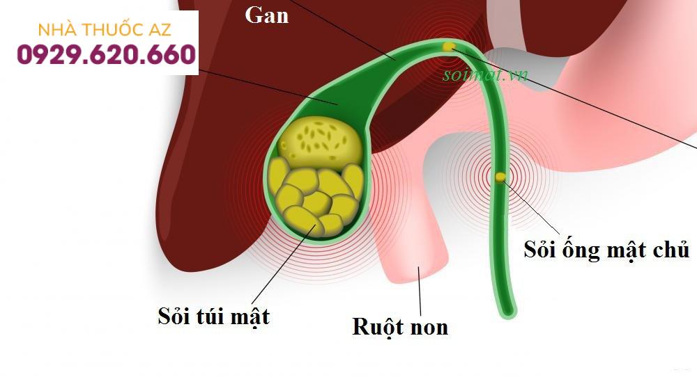 Nội soi mật tụy ngược dòng can thiệp nong đường mật bằng bóng chỉ định cho người bệnh sỏi ống mật chủ