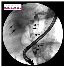 Sỏi ống mật chủ gây viêm đường mật cấp