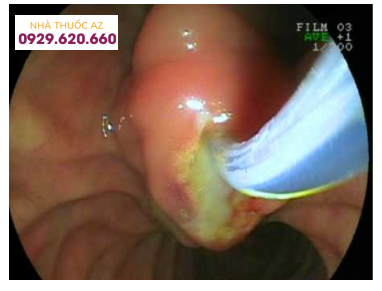 Mủ chảy ra từ đường mật qua bóng Vater