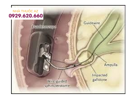 Can thiệp ERCP lấy sỏi gây viêm tụy cấp