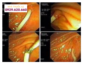 Hình ảnh giun chui ống mật được lấy qua ERCP