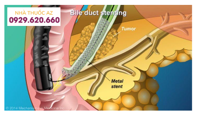 Đặt stent kim loại giải áp mật qua ERCP