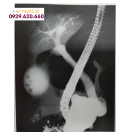 Barium còn đọng ở khung đại tràng che lấp một phần hình ảnh ống mật chủ vùng nhú Vater