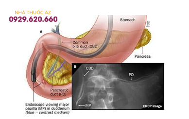 Kỹ thuật nội soi mật tụy ngược dòng