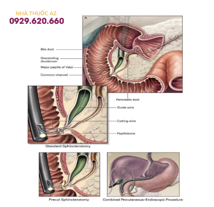 Các kỹ thuật cắt cơ vòng Oddi trong nội soi mật tụy ngược dòng