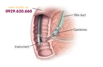 Thời gian thông nhú kéo dài là yếu tố nguy cơ của viêm tụy sau ERCP