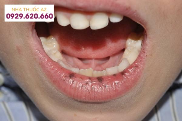 Biểu hiện của hội chứng Peutz-Jeghers