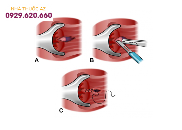 Nứt hậu môn có phải bệnh trĩ không?