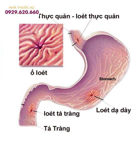 Thủng ổ loét dạ dày - tá tràng: Biến chứng nguy hiểm của viêm loét dạ dày - tá tràng