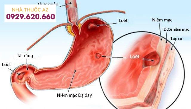 Viêm loét tá tràng biểu hiện thế nào?